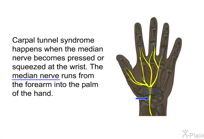 Carpal tunnel syndrome happens when the median nerve becomes pressed or squeezed at the wrist. The median nerve runs from the forearm into the palm of the hand.