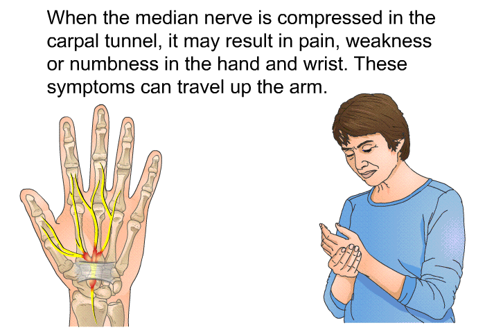 When the median nerve is compressed in the carpal tunnel, it may result in pain, weakness or numbness in the hand and wrist. These symptoms can travel up the arm.