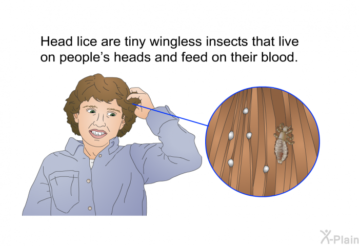 Head lice are tiny wingless insects that live on people's heads and feed on their blood.