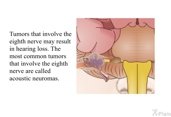 Tumors that involve the eighth nerve may result in hearing loss. The most common tumors that involve the eighth nerve are called acoustic neuromas.