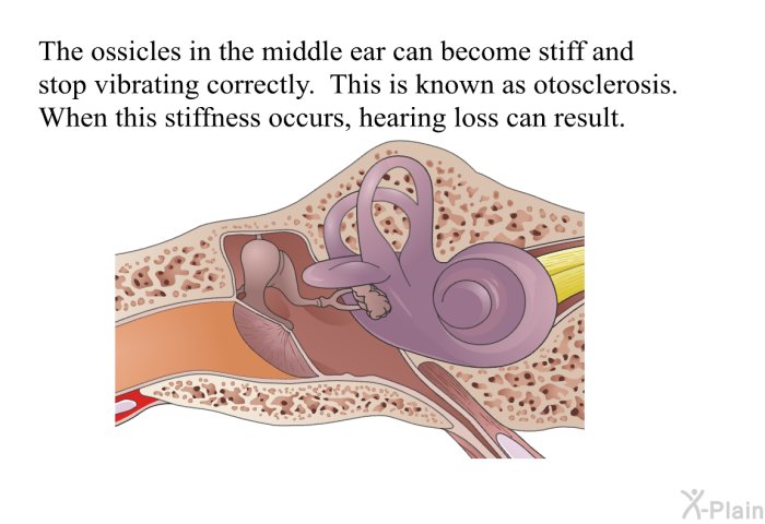 The ossicles in the middle ear can become stiff and stop vibrating correctly. This is known as otosclerosis. When this stiffness occurs, hearing loss can result.