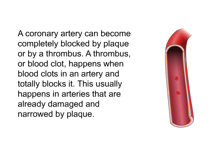 A coronary artery can become completely blocked by plaque or by a thrombus. A thrombus, or blood clot, happens when blood clots in an artery and totally blocks it. This usually happens in arteries that are already damaged and narrowed by plaque.