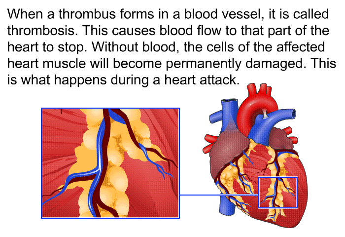 When a thrombus forms in a blood vessel, it is called thrombosis. This causes blood flow to that part of the heart to stop. Without blood, the cells of the affected heart muscle will become permanently damaged. This is what happens during a heart attack.