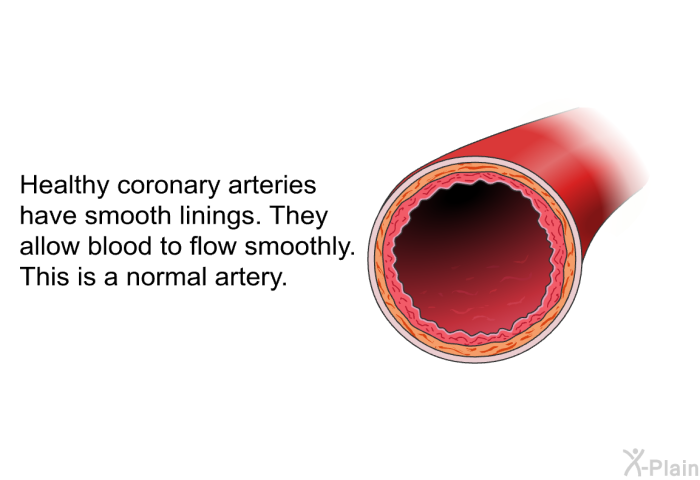 Healthy coronary arteries have smooth linings. They allow blood to flow smoothly. This is a normal artery.