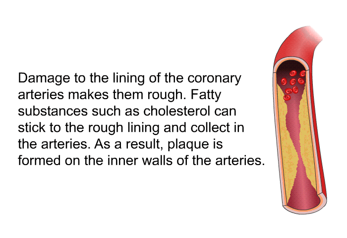 Damage to the lining of the coronary arteries makes them rough. Fatty substances such as cholesterol can stick to the rough lining and collect in the arteries. As a result, plaque is formed on the inner walls of the arteries.