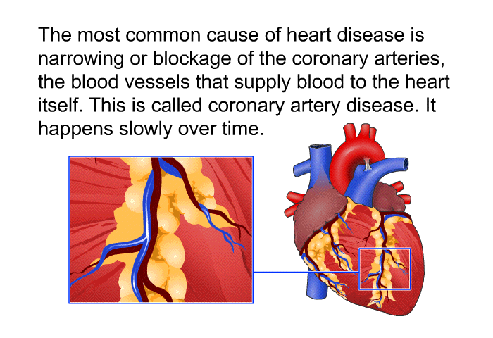 The most common cause of heart disease is narrowing or blockage of the coronary arteries, the blood vessels that supply blood to the heart itself. This is called coronary artery disease. It happens slowly over time.