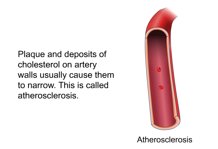 Plaque and deposits of cholesterol on artery walls usually cause them to narrow. This is called atherosclerosis.