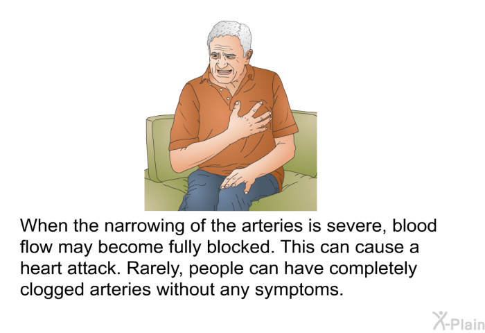 When the narrowing of the arteries is severe, blood flow may become fully blocked. This can cause a heart attack. Rarely, people can have completely clogged arteries without any symptoms.