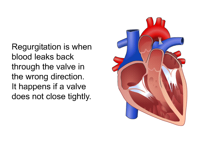 Regurgitation is when blood leaks back through the valve in the wrong direction. It happens if a valve does not close tightly.