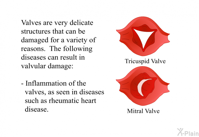 Valves are very delicate structures that can be damaged for a variety of reasons. The following diseases can result in valvular damage:  Inflammation of the valves, as seen in diseases such as rheumatic heart disease.