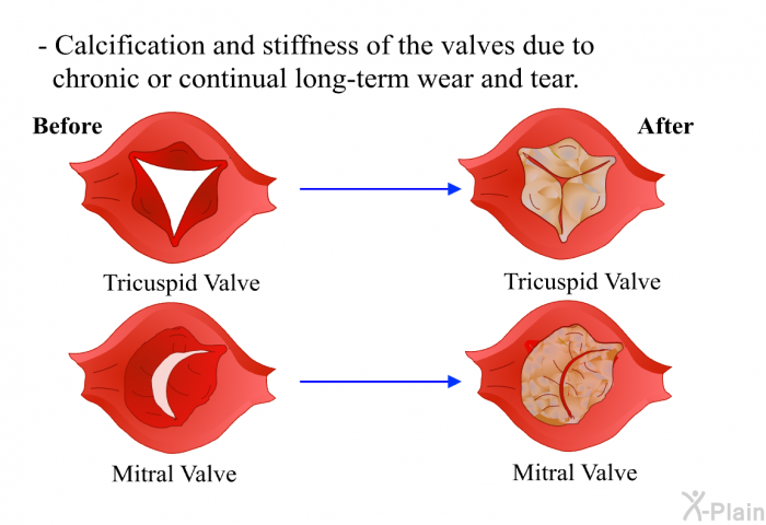 Calcification and stiffness of the valves due to chronic or continual long-term wear and tear.