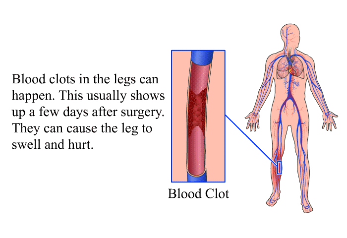 Blood clots in the legs can happen. This usually shows up a few days after surgery. They can cause the leg to swell and hurt.