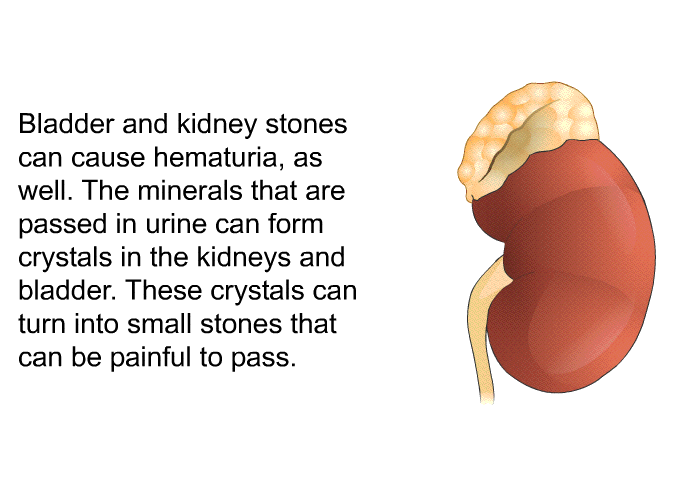 Bladder and kidney stones can cause hematuria, as well. The minerals that are passed in urine can form crystals in the kidneys and bladder. These crystals can turn into small stones that can be painful to pass.