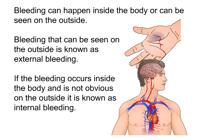 Bleeding can happen inside the body or can be seen on the outside. Bleeding that can be seen on the outside is known as external bleeding. If the bleeding occurs inside the body and is not obvious on the outside it is known as internal bleeding.