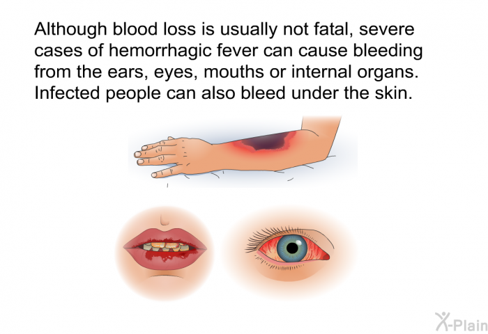 Although blood loss is usually not fatal, severe cases of hemorrhagic fever can cause bleeding from the ears, eyes, mouths or internal organs. Infected people can also bleed under the skin.
