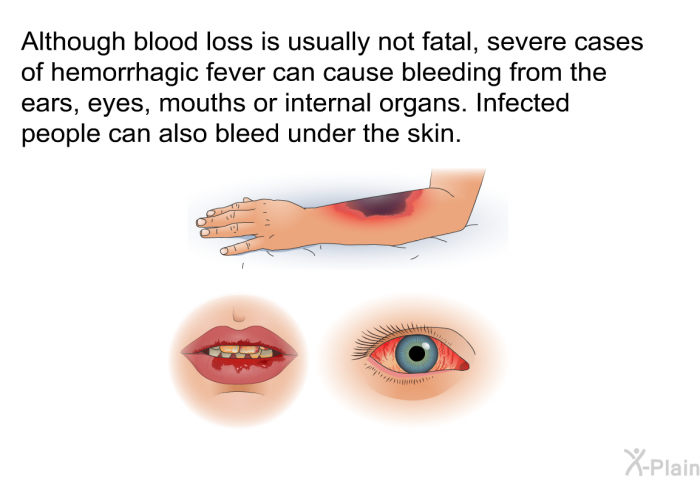Although blood loss is usually not fatal, severe cases of hemorrhagic fever can cause bleeding from the ears, eyes, mouths or internal organs. Infected people can also bleed under the skin.