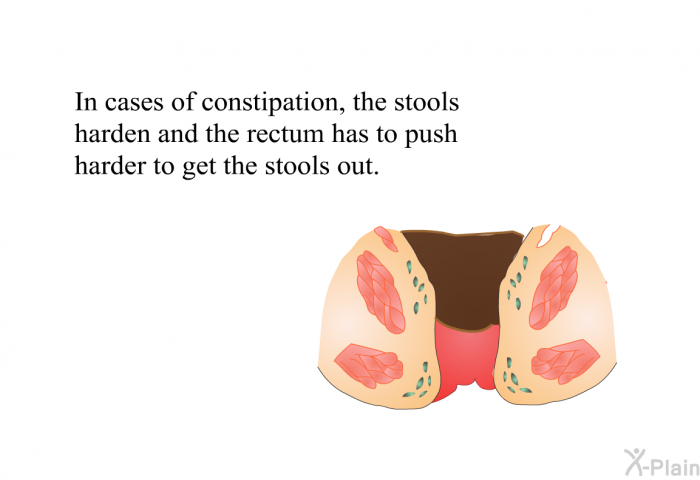 In cases of constipation, the stools harden and the rectum has to push harder to get the stools out.