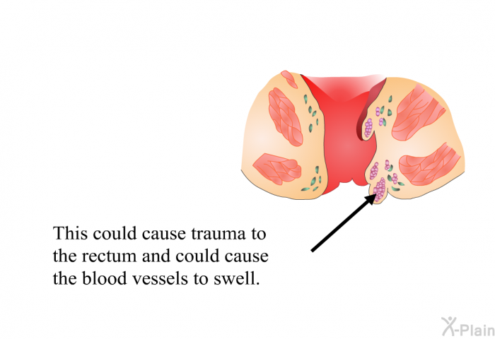 This could cause trauma to the rectum and could cause the blood vessels to swell.