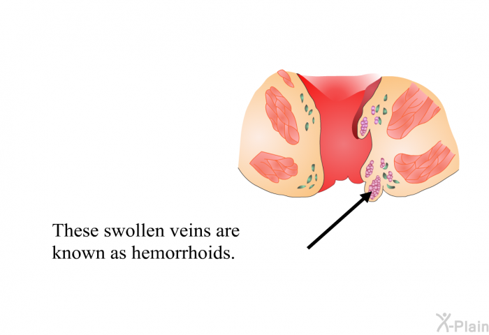 These swollen veins are known as hemorrhoids.