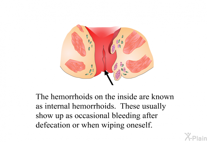 The hemorrhoids on the inside are known as internal hemorrhoids. These usually show up as occasional bleeding after defecation or when wiping oneself.