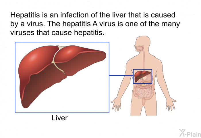 Hepatitis is an infection of the liver that is caused by a virus. The hepatitis A virus is one of the many viruses that cause hepatitis.