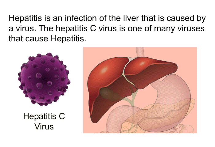 Hepatitis is an infection of the liver that is caused by a virus. The hepatitis C virus is one of many viruses that cause hepatitis.