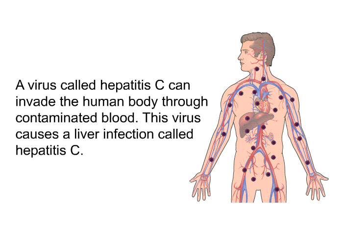A virus called hepatitis C can invade the human body through contaminated blood. This virus causes a liver infection called hepatitis C.