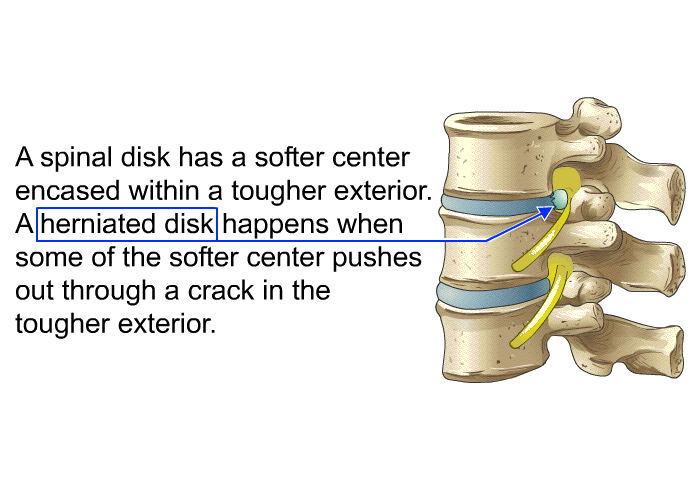 A spinal disk has a softer center encased within a tougher exterior. A herniated disk happens when some of the softer center pushes out through a crack in the tougher exterior.