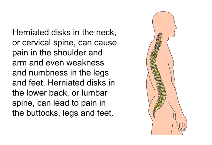 Herniated disks in the neck, or cervical spine, can cause pain in the shoulder and arm and even weakness and numbness in the legs and feet. Herniated disks in the lower back, or lumbar spine, can lead to pain in the buttocks, legs and feet.