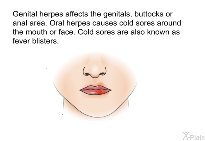 Genital herpes affects the genitals, buttocks or anal area. Oral herpes causes cold sores around the mouth or face. Cold sores are also known as fever blisters.