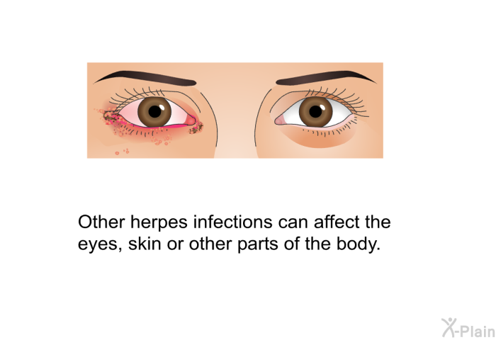 Other herpes infections can affect the eyes, skin or other parts of the body.
