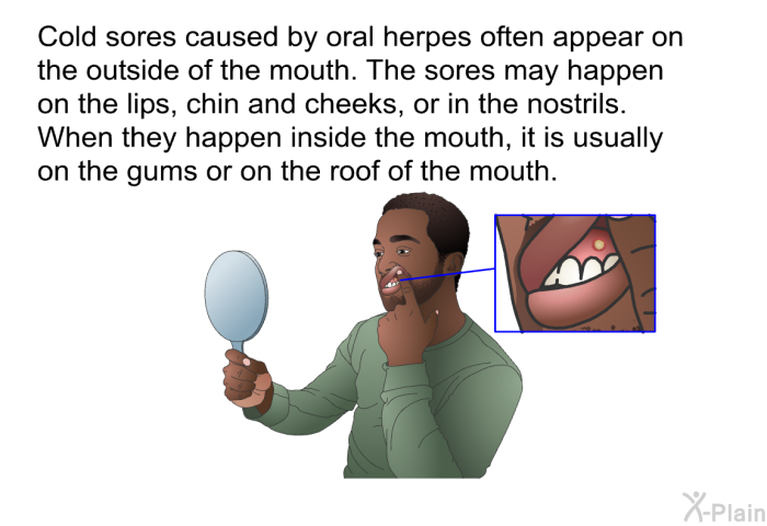 Cold sores caused by oral herpes often appear on the outside of the mouth. The sores may happen on the lips, chin and cheeks, or in the nostrils. When they happen inside the mouth, it is usually on the gums or on the roof of the mouth.