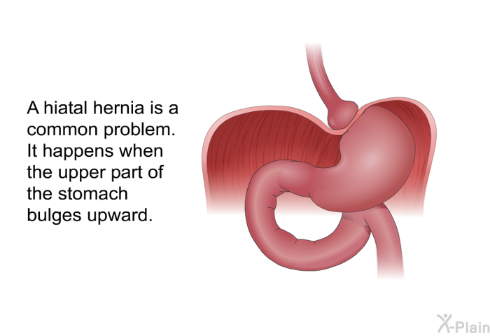 A hiatal hernia is a common problem. It happens when the upper part of the stomach bulges upward.