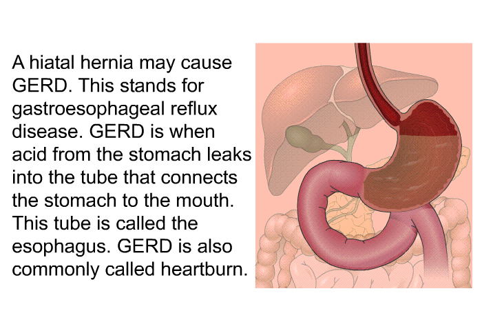 A hiatal hernia may cause GERD. This stands for gastroesophageal reflux disease. GERD is when acid from the stomach leaks into the tube that connects the stomach to the mouth. This tube is called the esophagus. GERD is also commonly called heartburn.