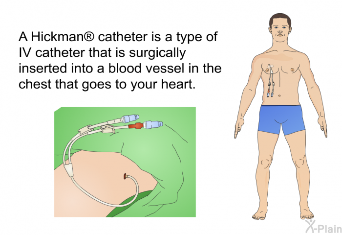 A Hickman  catheter is a type of IV catheter that is surgically inserted into a blood vessel in the chest that goes to your heart.