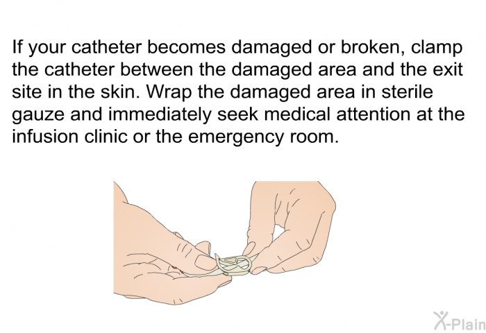 If your catheter becomes damaged or broken, clamp the catheter between the damaged area and the exit site in the skin. Wrap the damaged area in sterile gauze and immediately seek medical attention at the infusion clinic or the emergency room.