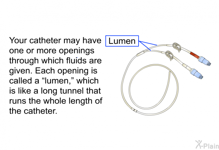 Your catheter may have one or more openings through which fluids are given. Each opening is called a “lumen,” which is like a long tunnel that runs the whole length of the catheter.