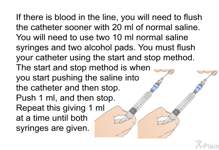 If there is blood in the line, you will need to flush the catheter sooner with 20 ml of normal saline. <B>You will need to use two 10 ml normal saline syringes and two alcohol pads</B>. You must flush your catheter using the start and stop method. The start and stop method is when you start pushing the saline into the catheter and then stop. Push 1 ml, and then stop. <B>Repeat this giving 1 ml at a time until both syringes are given.</B>