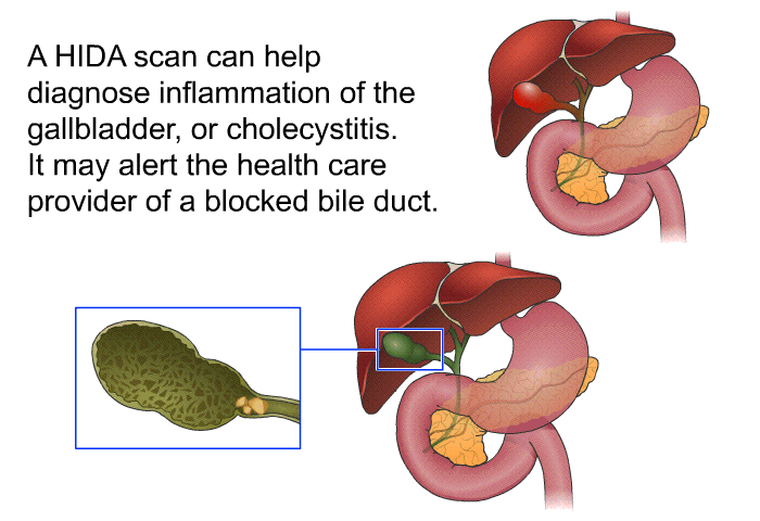 A HIDA scan can help diagnose inflammation of the gallbladder, or cholecystitis. It may alert the health care provider of a blocked bile duct.