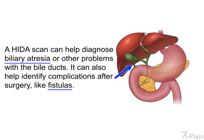 A HIDA scan can help diagnose biliary atresia or other problems with the bile ducts. It can also help identify complications after surgery, like fistulas.