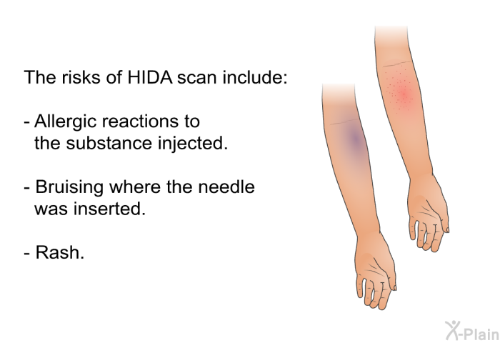 The risks of HIDA scan include:  Allergic reactions to the substance injected. Bruising where the needle was inserted. Rash.