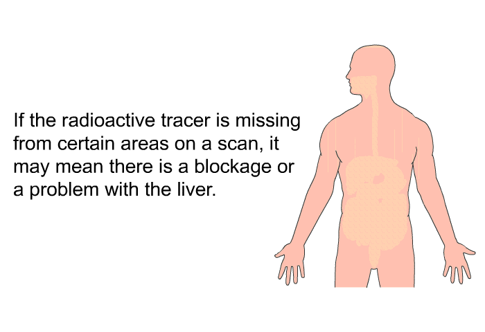 If the radioactive tracer is missing from certain areas on a scan, it may mean there is a blockage or a problem with the liver.