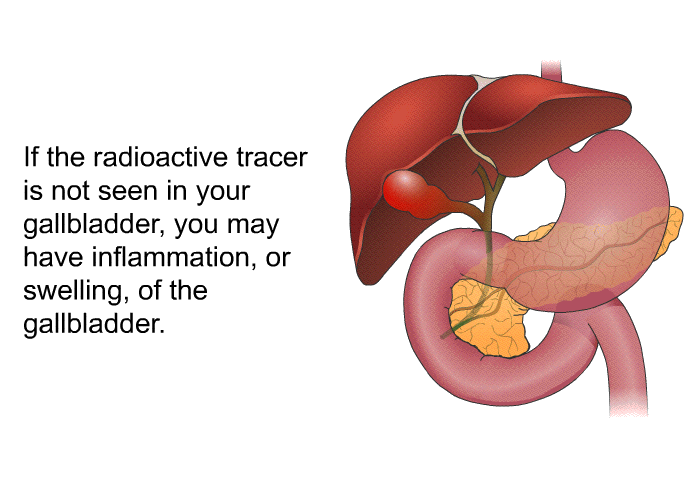 If the radioactive tracer is not seen in your gallbladder, you may have inflammation, or swelling, of the gallbladder.