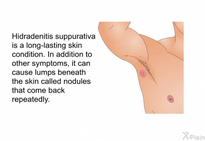 Hidradenitis suppurativa is a long-lasting skin condition. In addition to other symptoms, it can cause lumps beneath the skin called nodules that come back repeatedly.