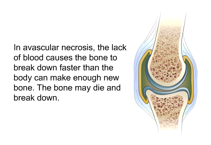 In avascular necrosis, the lack of blood causes the bone to break down faster than the body can make enough new bone. The bone may die and break down.