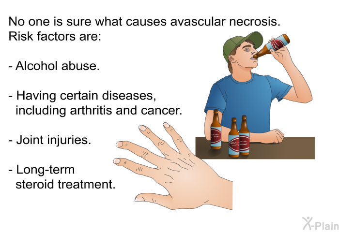 No one is sure what causes avascular necrosis. Risk factors are:  Alcohol abuse. Having certain diseases, including arthritis and cancer. Joint injuries. Long-term steroid treatment.