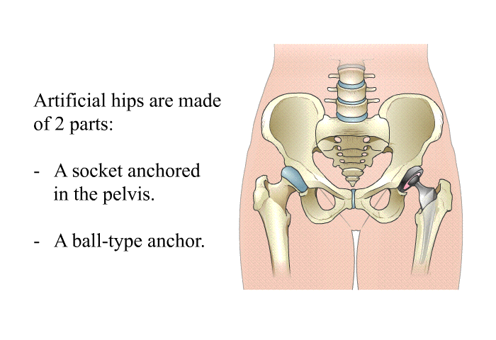 Artificial hips are made of 2 parts:  A socket anchored in the pelvis.  A ball-type anchor.