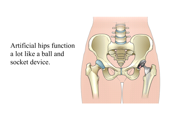 Artificial hips function a lot like a ball and socket device.