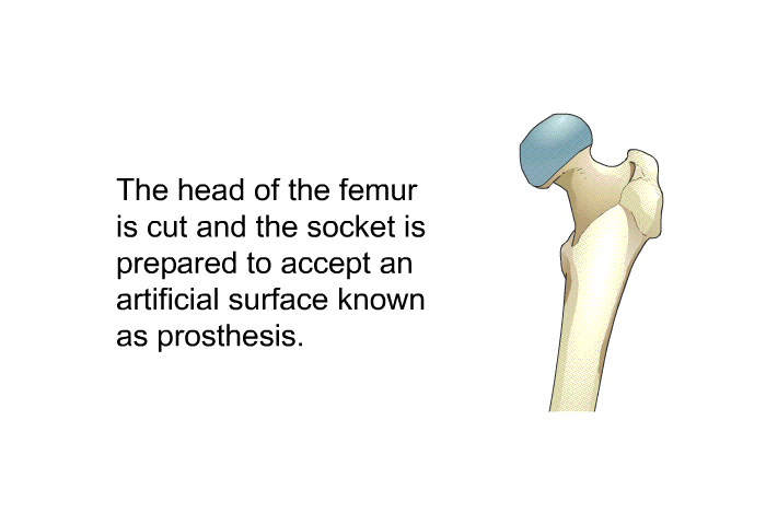 The head of the femur is cut and the socket is prepared to accept an artificial surface known as prosthesis.