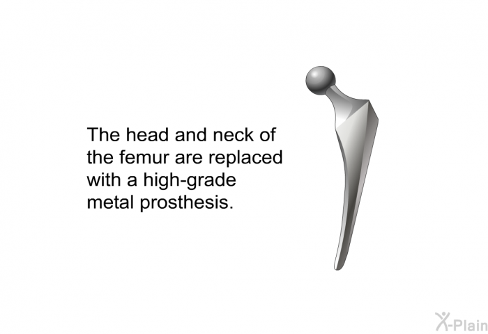 The head and neck of the femur are replaced with a high-grade metal prosthesis.